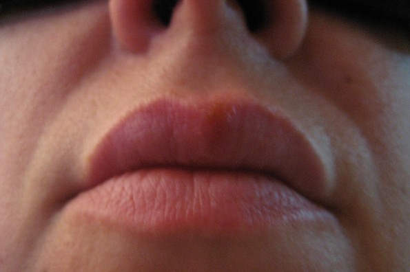 Tips para evitar el herpes labial