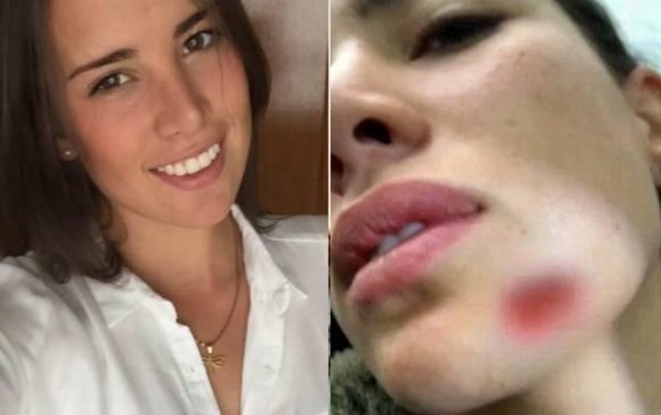Modelo colombiana es atacada a mordidas por su ex novio ¡Por los celos!
