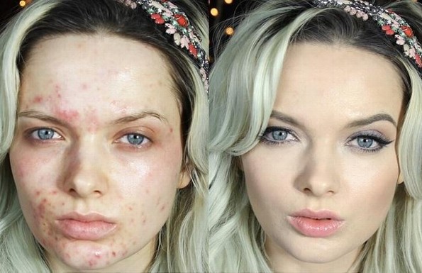 ¡Ella era criticada por tener acné hasta que lanzó este poderoso mensaje!