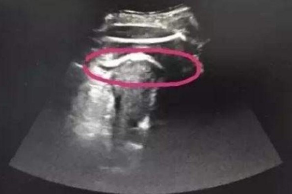 Embarazada casi muere ¡por una patada de su bebé! (+FOTO)