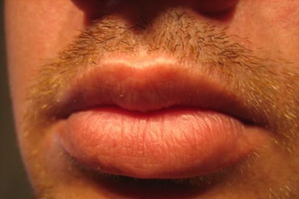 Revela estudio que uno de cada nueve hombres tiene VPH en la boca