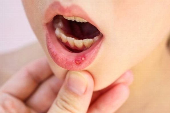 Recomiendan estar atentos ante presencia de llagas en la boca 