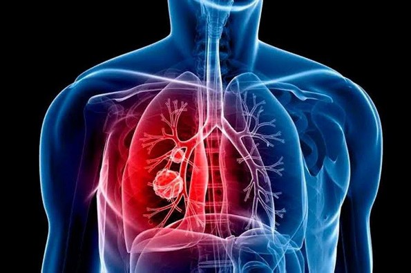 Recomiendan estar atentos a síntomas de neumonía para un diagnóstico oportuno