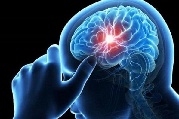 ¿Qué es el Aneurisma Cerebral? Checa síntomas