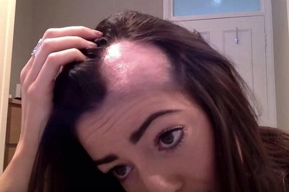 ¿A qué se debe la alopecia? ¿Hay manera de tratarla?