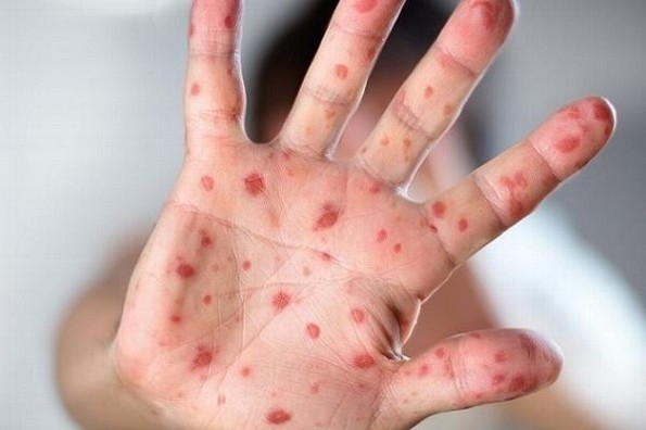 ¿Qué es la viruela del mono?