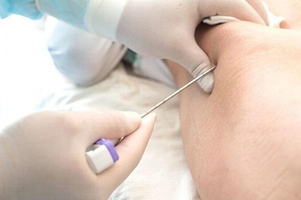 ¿Por qué es importante un estudio de médula ósea si se sospecha de cáncer de sangre?