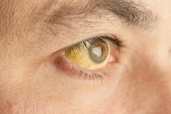 10 datos que debes saber sobre la Hepatitis Viral