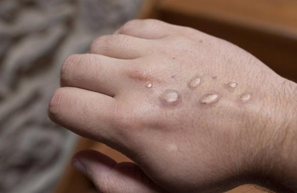 ¿Estás inmune contra la viruela del mono si te vacunaron de niño contra la 