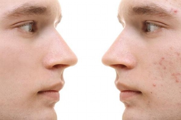 El ABC sobre el acné 