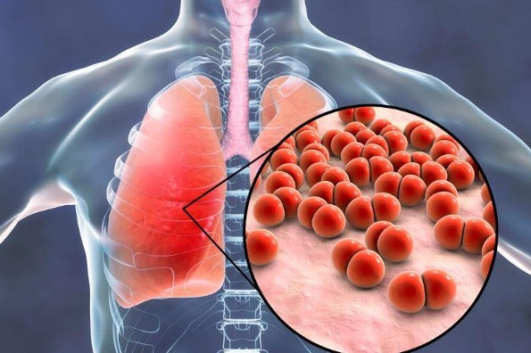 Época invernal: 9 datos sobre las enfermedades neumocócicas