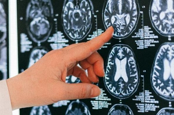 ¿Qué es la encefalitis? Estos son los síntomas 