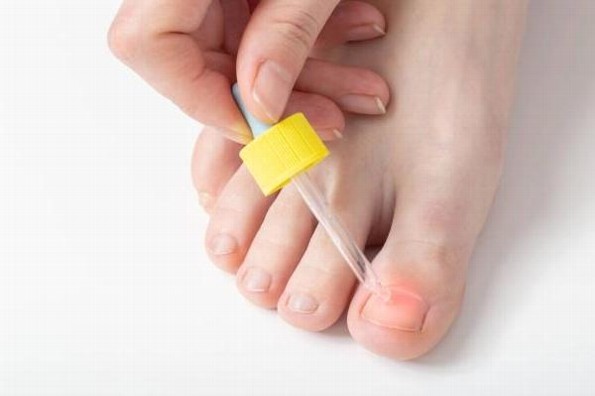 ¿Padeces onicomicosis? No te preocupes, tiene cura 