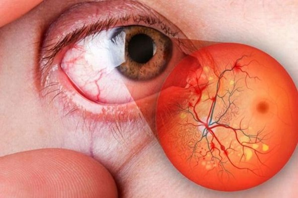 Esto debes saber sobre la retinopatía diabética 