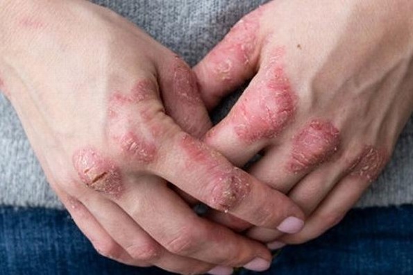 Dermatitis Atópica puede afectar fuertemente la salud mental del paciente