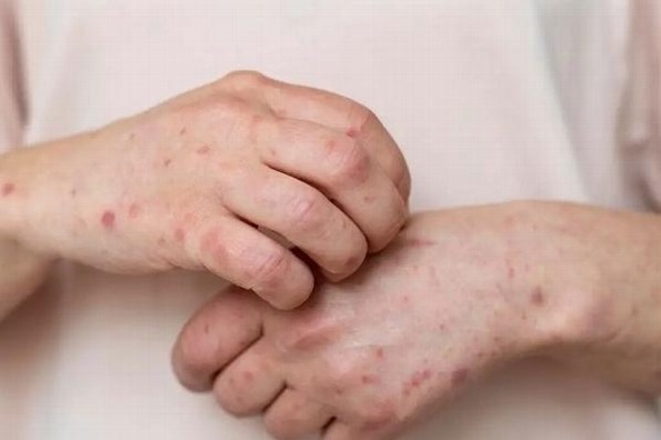 ¿Cómo se contagia el sarampión y cuándo se deben aplicar las vacunas?