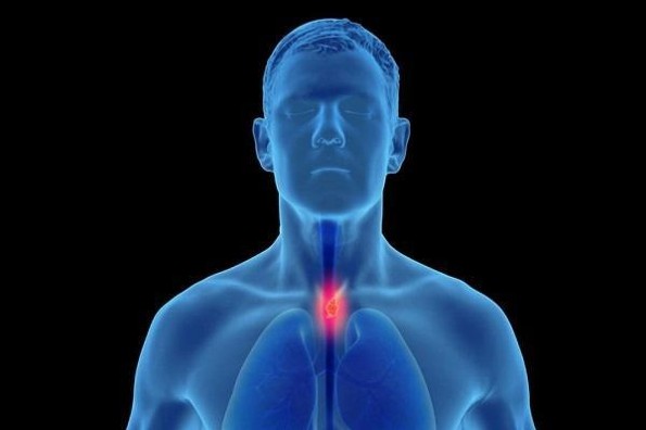 ¿Qué es el cáncer de esófago y cuáles son sus síntomas?