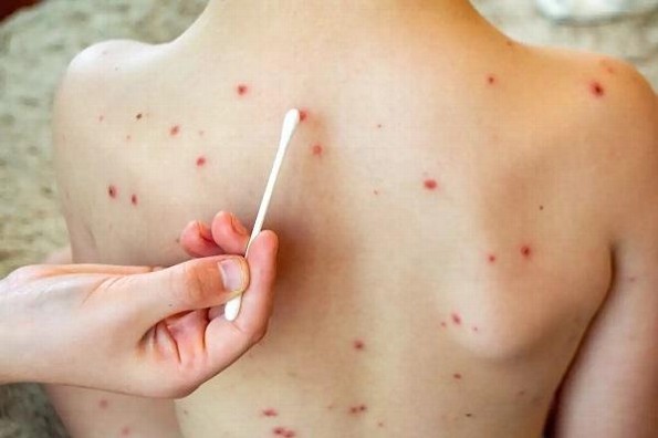 ¿Cómo prevenir el sarampión y cuáles son sus síntomas?