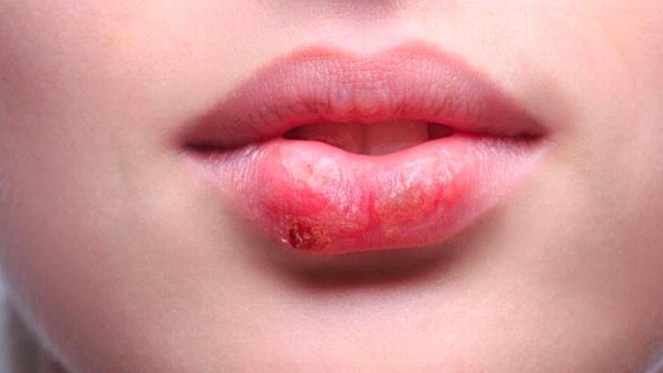 ¿Qué causa el fuego labial y como curarlo? ¡Aquí te lo decimos! 