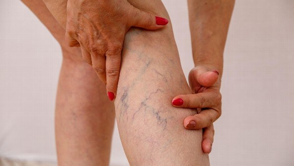 ¿Tienes várices? ¡Aquí unos tips para aminorar las molestias!