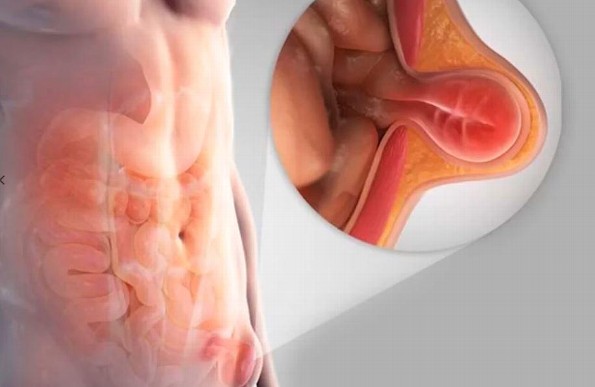 Hernias: ¿Qué son, por qué ocurren y cómo se tratan?
