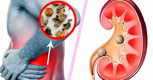 Todo lo que Debes Saber sobre las Piedras en los Riñones