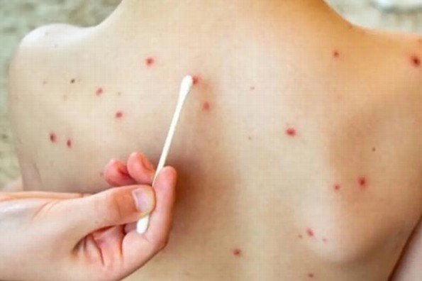 ¿Por qué es tan peligroso el sarampión? Estos son sus efectos más graves